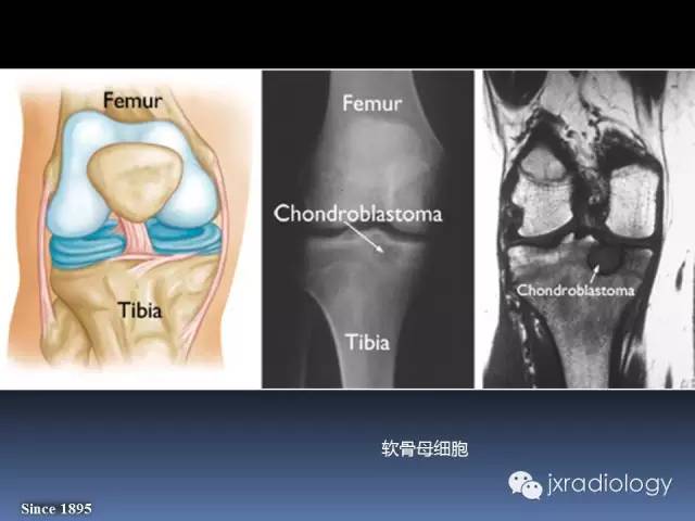 【PPT】硬化性骨肿瘤或肿瘤样病变