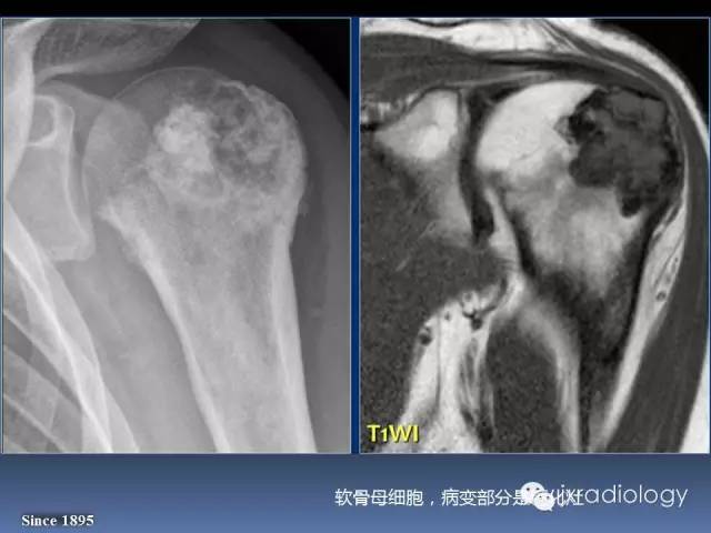 【PPT】硬化性骨肿瘤或肿瘤样病变