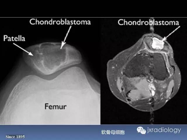 【PPT】硬化性骨肿瘤或肿瘤样病变