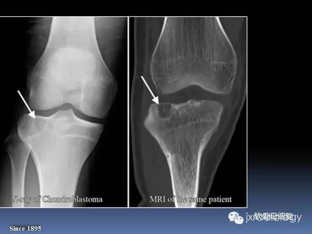 【PPT】硬化性骨肿瘤或肿瘤样病变