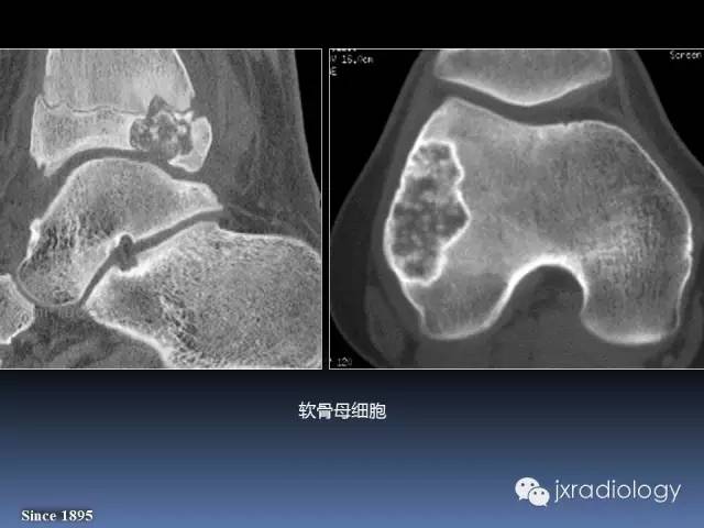 【PPT】硬化性骨肿瘤或肿瘤样病变