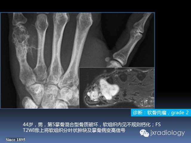 【PPT】硬化性骨肿瘤或肿瘤样病变