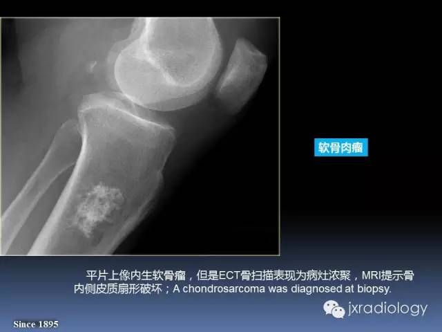 【PPT】硬化性骨肿瘤或肿瘤样病变