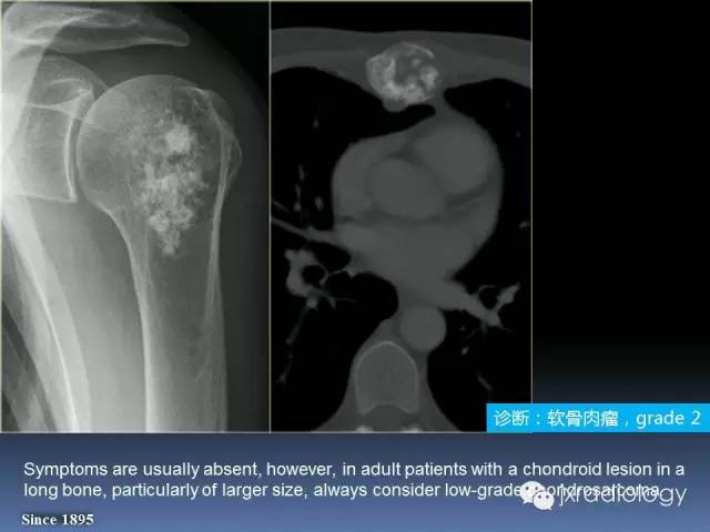 【PPT】硬化性骨肿瘤或肿瘤样病变