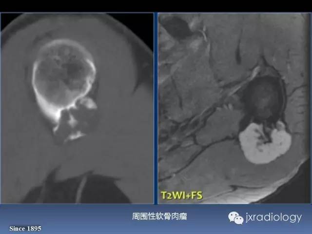 【PPT】硬化性骨肿瘤或肿瘤样病变