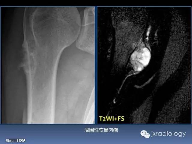 【PPT】硬化性骨肿瘤或肿瘤样病变