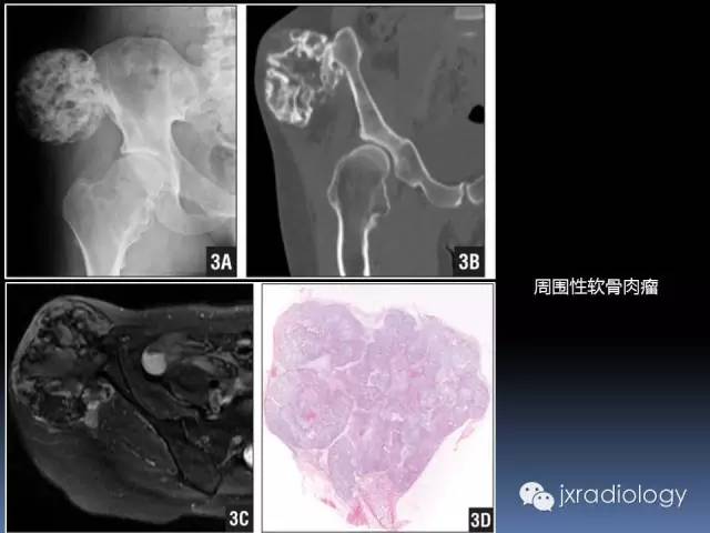 【PPT】硬化性骨肿瘤或肿瘤样病变