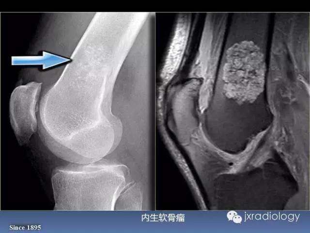 【PPT】硬化性骨肿瘤或肿瘤样病变