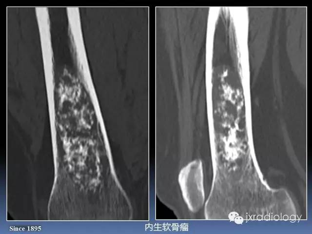 【PPT】硬化性骨肿瘤或肿瘤样病变