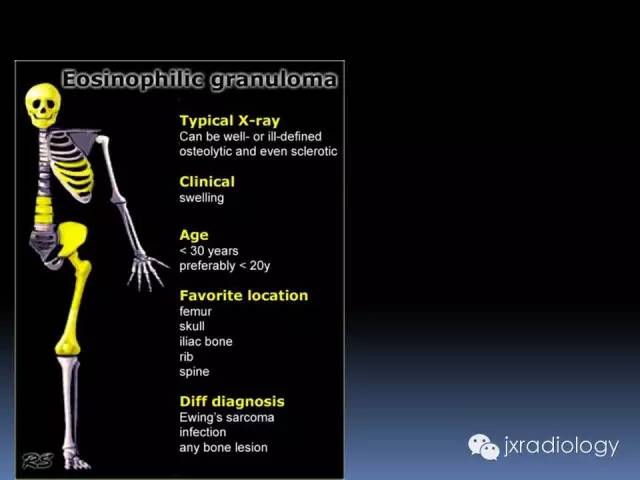 【PPT】硬化性骨肿瘤或肿瘤样病变