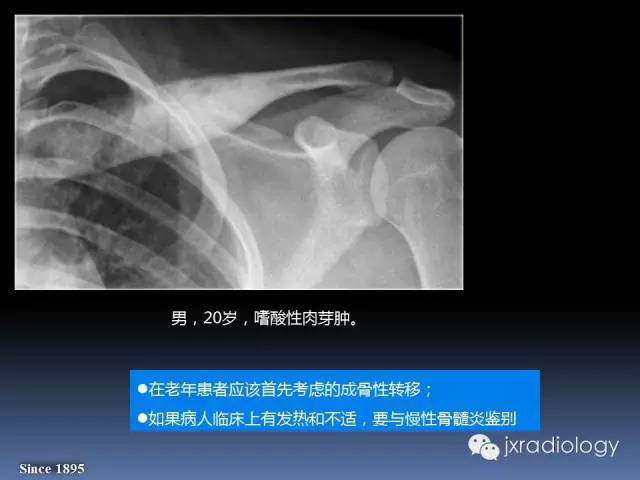 【PPT】硬化性骨肿瘤或肿瘤样病变