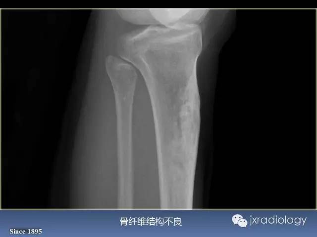 【PPT】硬化性骨肿瘤或肿瘤样病变