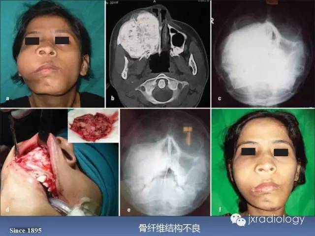 【PPT】硬化性骨肿瘤或肿瘤样病变