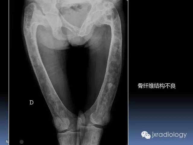 【PPT】硬化性骨肿瘤或肿瘤样病变