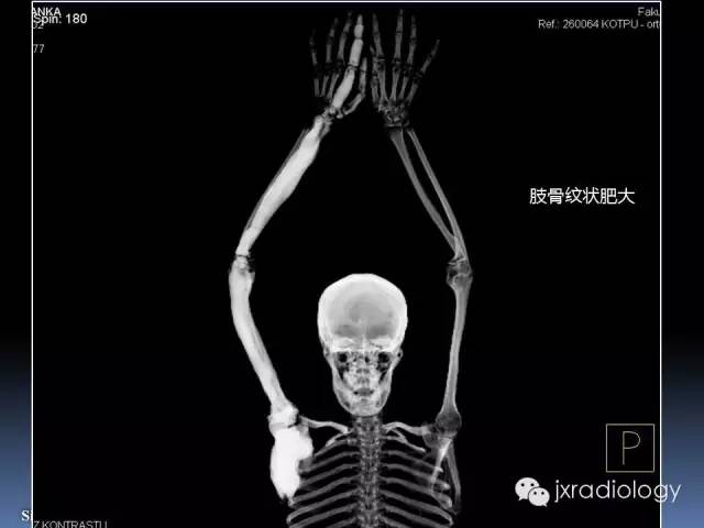 【PPT】硬化性骨肿瘤或肿瘤样病变