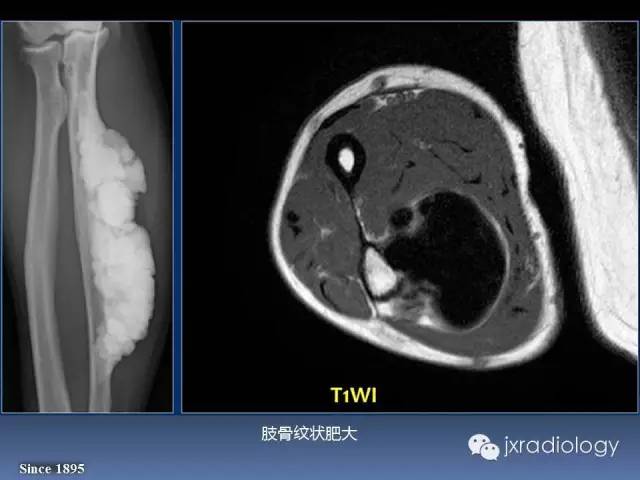【PPT】硬化性骨肿瘤或肿瘤样病变