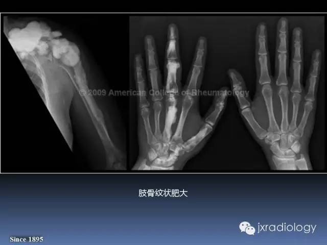 【PPT】硬化性骨肿瘤或肿瘤样病变