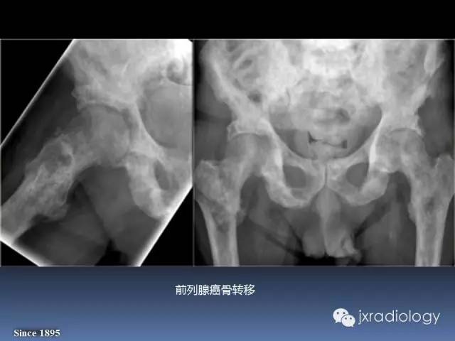 【PPT】硬化性骨肿瘤或肿瘤样病变