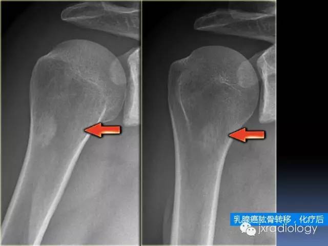【PPT】硬化性骨肿瘤或肿瘤样病变