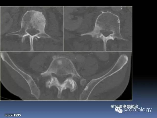 【PPT】硬化性骨肿瘤或肿瘤样病变