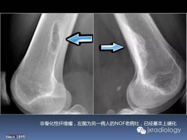 【PPT】硬化性骨肿瘤或肿瘤样病变