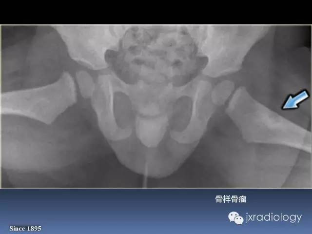 【PPT】硬化性骨肿瘤或肿瘤样病变