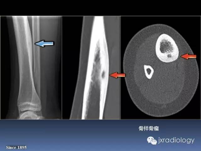 【PPT】硬化性骨肿瘤或肿瘤样病变