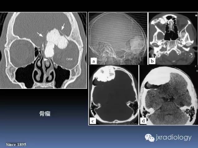 【PPT】硬化性骨肿瘤或肿瘤样病变