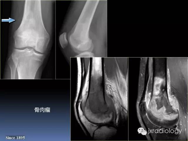 【PPT】硬化性骨肿瘤或肿瘤样病变