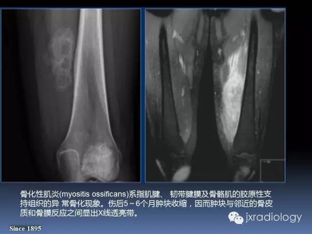 【PPT】硬化性骨肿瘤或肿瘤样病变