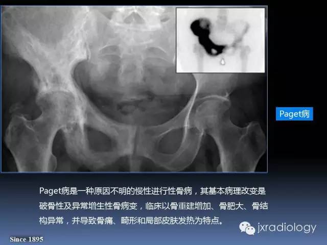 【PPT】硬化性骨肿瘤或肿瘤样病变