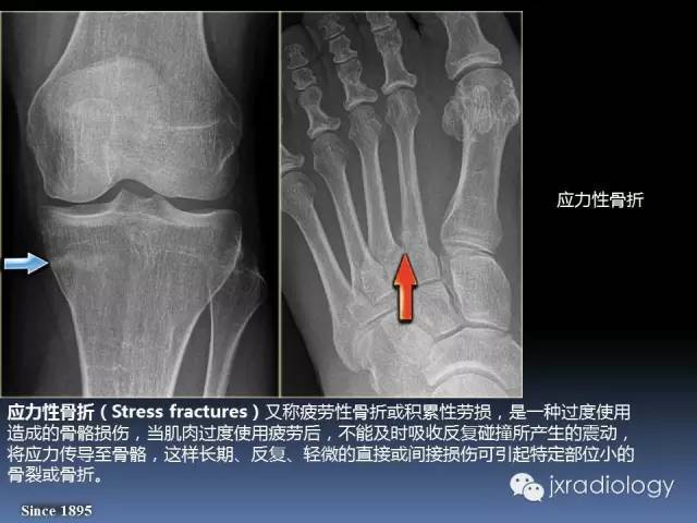 【PPT】硬化性骨肿瘤或肿瘤样病变