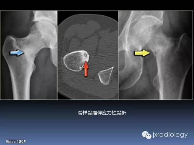 【PPT】硬化性骨肿瘤或肿瘤样病变