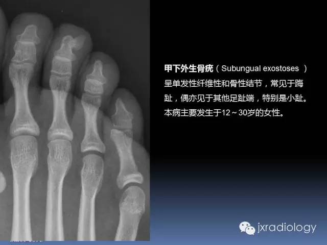 【PPT】硬化性骨肿瘤或肿瘤样病变