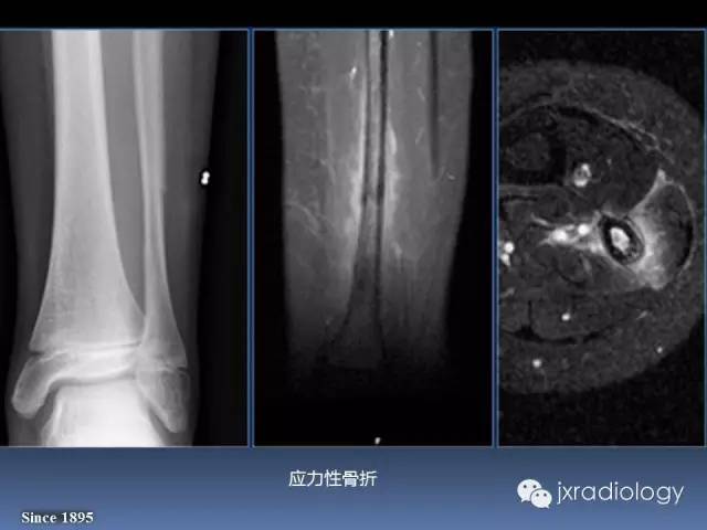 【PPT】硬化性骨肿瘤或肿瘤样病变