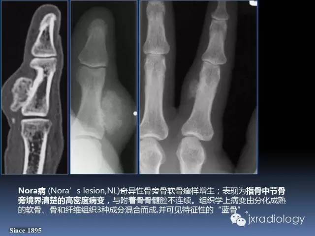 【PPT】硬化性骨肿瘤或肿瘤样病变