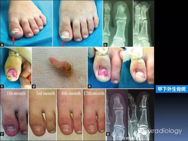 【PPT】硬化性骨肿瘤或肿瘤样病变