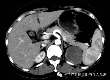 【病例】肾上腺嗜铬细胞瘤1例CT影像表现 【病例】肾上腺嗜铬细胞瘤1例CT影像表现