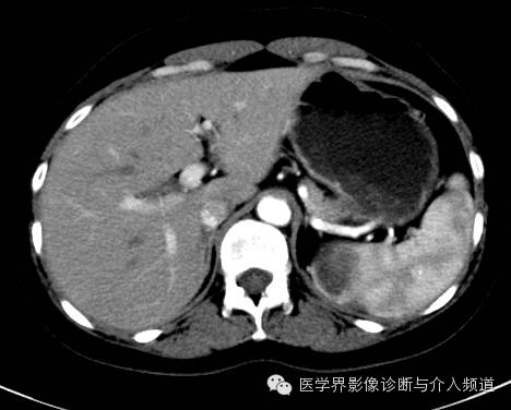 【病例】肾上腺嗜铬细胞瘤1例CT影像表现