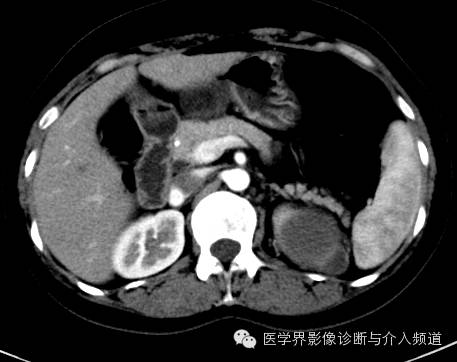 【病例】肾上腺嗜铬细胞瘤1例CT影像表现 【病例】肾上腺嗜铬细胞瘤1例CT影像表现