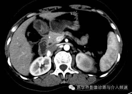 【病例】肾上腺嗜铬细胞瘤1例CT影像表现 【病例】肾上腺嗜铬细胞瘤1例CT影像表现