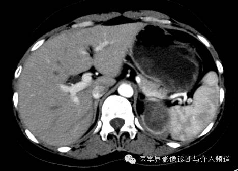【病例】肾上腺嗜铬细胞瘤1例CT影像表现 【病例】肾上腺嗜铬细胞瘤1例CT影像表现