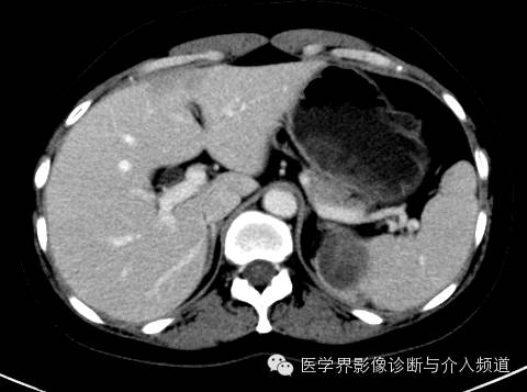 【病例】肾上腺嗜铬细胞瘤1例CT影像表现 【病例】肾上腺嗜铬细胞瘤1例CT影像表现