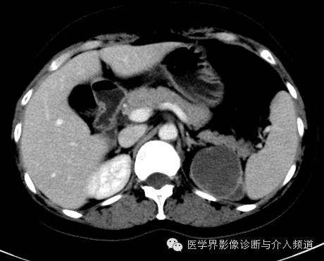 【病例】肾上腺嗜铬细胞瘤1例CT影像表现 【病例】肾上腺嗜铬细胞瘤1例CT影像表现