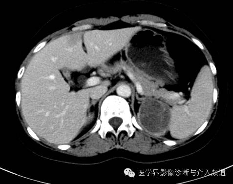 【病例】肾上腺嗜铬细胞瘤1例CT影像表现 【病例】肾上腺嗜铬细胞瘤1例CT影像表现