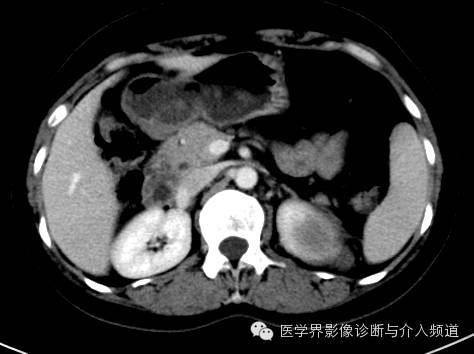 【病例】肾上腺嗜铬细胞瘤1例CT影像表现 【病例】肾上腺嗜铬细胞瘤1例CT影像表现