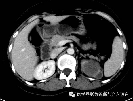 【病例】肾上腺嗜铬细胞瘤1例CT影像表现 【病例】肾上腺嗜铬细胞瘤1例CT影像表现