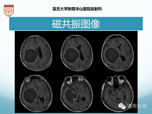 【病例】幕上毛细胞型星形细胞瘤1例MR影像表现