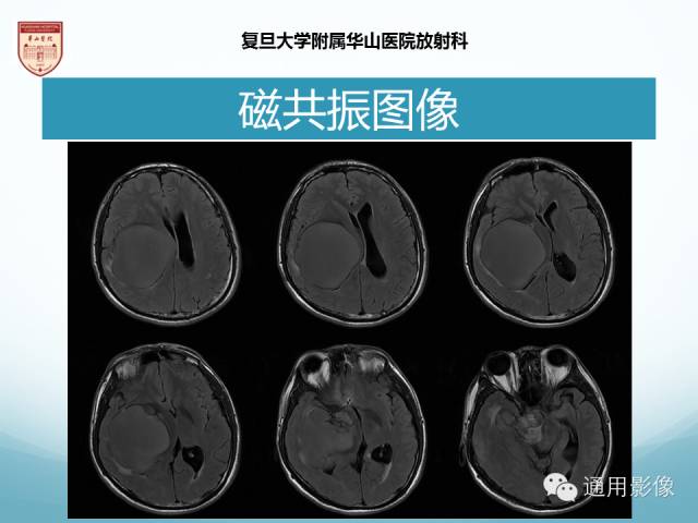 【病例】幕上毛细胞型星形细胞瘤1例MR影像表现