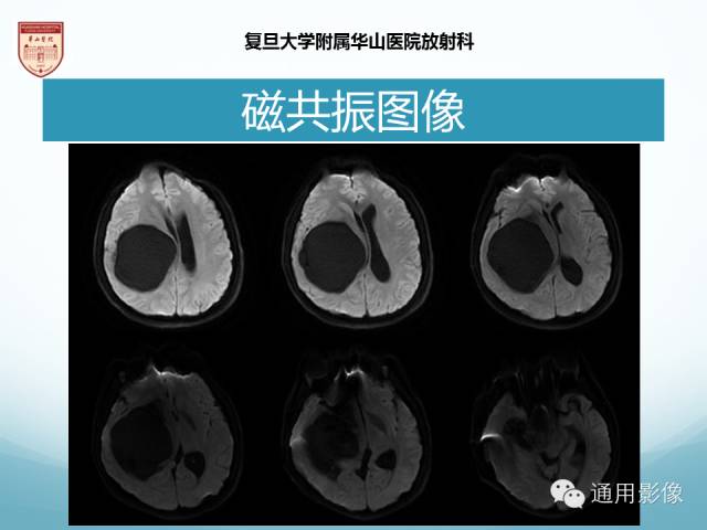【病例】幕上毛细胞型星形细胞瘤1例MR影像表现